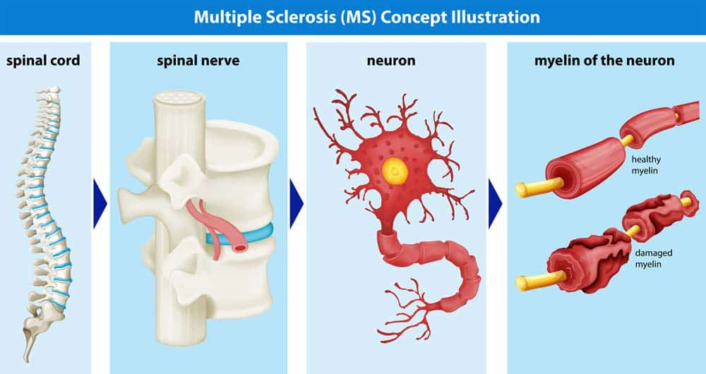 esclerosis multiple