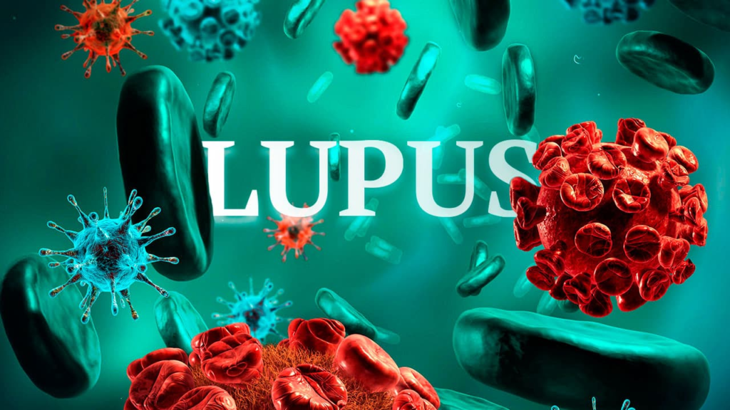 Lupus