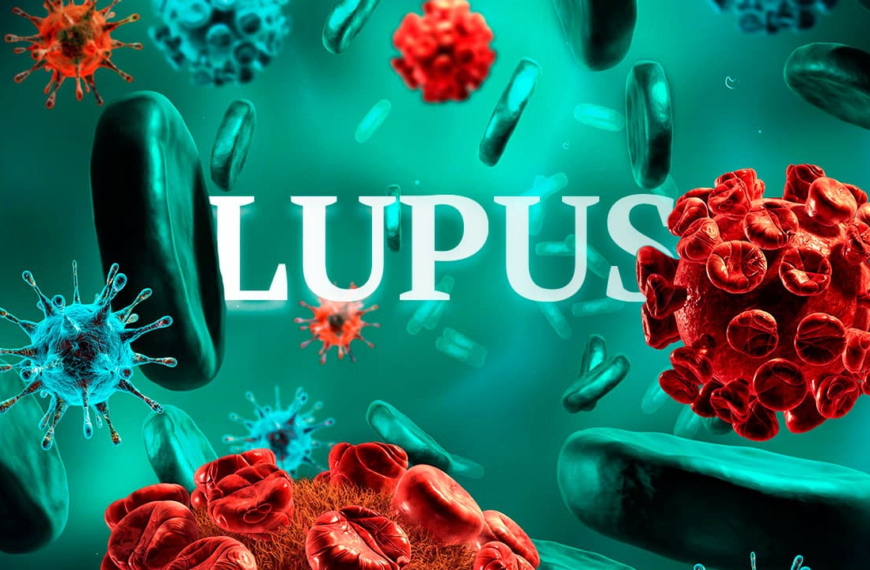 Lupus